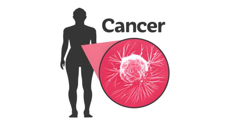A human silhouette with the word 'Cancer' in bold letters beside it. A pink magnifying glass reveals a detailed, magnified cancer cell in shades of pink and white, highlighting its complex and invasive structures and tendrils.